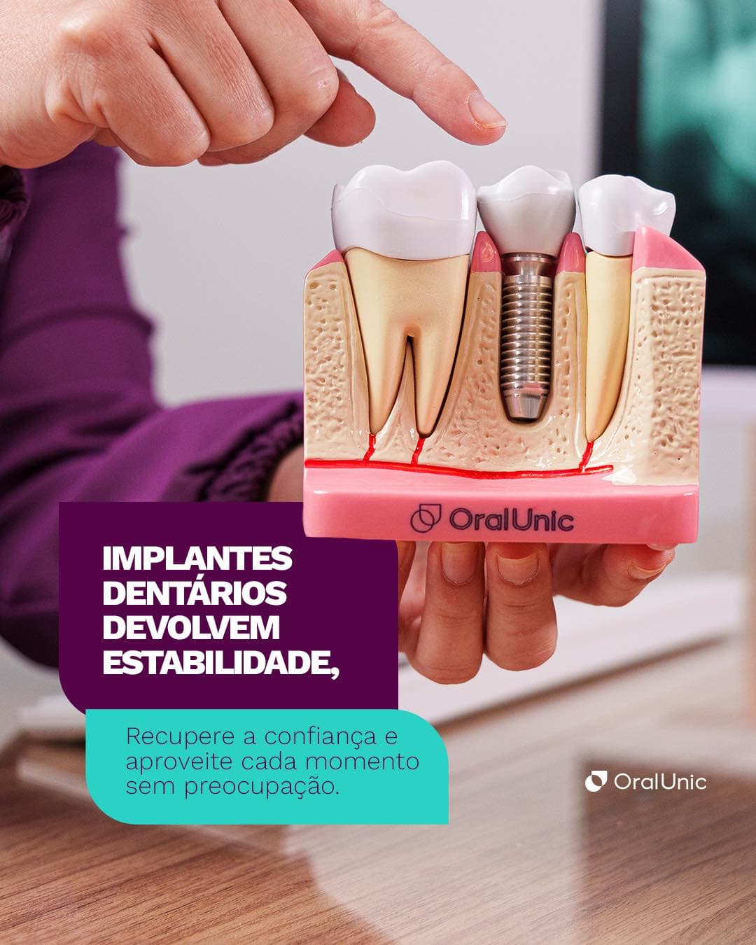 Modelo de implante dentário com bom foco e iluminação.